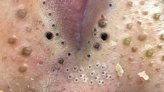 Big Cystic Acne Blackheads Extraction Blackheads amp Milia Whiteheads Removal Pimple Popping  9121 [upl. by Yhprum]