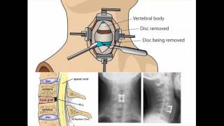 Spine Conference Adjacent Level Degeneration following ACDF [upl. by Orvah]