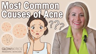 The Main Causes of Acne amp How To Combat Acne Prone Skin  GLOWBIOTICS [upl. by Joed]