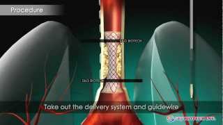 SampG BiotechEGIS Airway Stent [upl. by Fernyak]