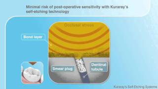 Kuraray Selfetch demonstration  dental use [upl. by Bechler]