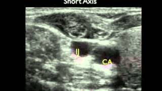 Video procedurale Guida con ecografia per laccesso venoso centrale parte 2 [upl. by Ahsirtak]