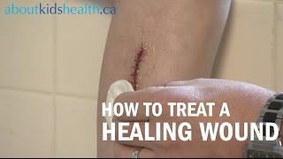 How to care for a healing wound  AboutKidsHealth at The Hospital for Sick Children [upl. by Olivann]