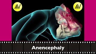 Anencephaly Explained [upl. by Kaleena]