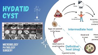 Hydatid cyst [upl. by Aplihs]