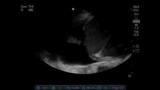 Pleural effusion ultrasound [upl. by Attenwahs]