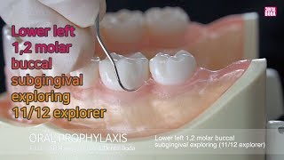 Lower left 12 molar buccal subgingival exploring 1112 explorer [upl. by Dirraj]