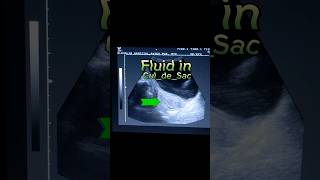 Pelvic Inflammatory Disease  PID  CuldeSac Fluid  Fluid in POD Pouch of Douglas in Ultrasound [upl. by Nwahsek766]