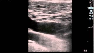 Ultrasound Guided Subclavian Vein Cannulation [upl. by Branscum]