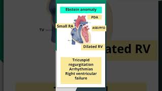 Ebstein Anomaly box shaped heart neetpg xray nextpg mnemonics shorts education pediatrics [upl. by Htyderem]