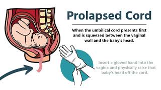 Pregnancy amp Delivery Emergencies in EMS [upl. by Inahet]