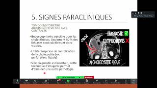 Cholécystite aigue Dr AING PITOU [upl. by Jarlath]