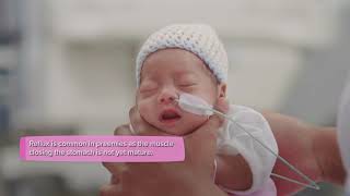 Premature baby  Nutrition and feeding [upl. by Nefets]