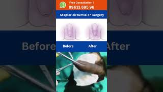 Circumcision surgery Stapler PhimosisSwollen Penis Treatment hospital doctor hyderabad [upl. by Aveer]