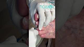 Nails Treatment callus κεντροποδιου kentropodiou podiatry podiatria podologia podiatrist [upl. by Audris887]