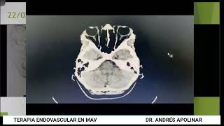 Terapia endovascular en malformaciones arteriovenosas cerebrales [upl. by Aan]