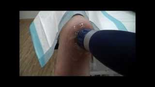 Plantar Fasciitis [upl. by Selie]