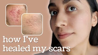 Healing Hyperpigmentation  Deep Pitted Acne Scars this is what I’ve done [upl. by Ikaz197]