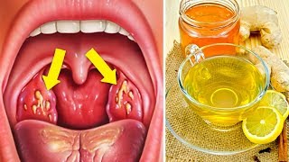 How to Cure Tonsillitis Fast and Naturally [upl. by Otreblada]