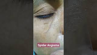 Spider Angioma in Face in CLD Patient  Spider angioma  Diascopy [upl. by Feriga701]