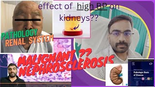 MALIGNANT NEPHROSCLEROSISEFFECT OF ACCLERATED HYPERTENSION ON KIDNEY PART 22  NEPHROLOGY [upl. by Leinaj183]