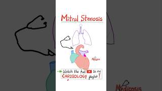 Mitral Stenosis MS  Valvular Heart Diseases VHD Part 2…anatomy mbbs cardio cardiology [upl. by Hitoshi]