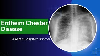 ERDHEIM CHESTER DISEASE  A Rare multisystem disorder [upl. by Jobyna]