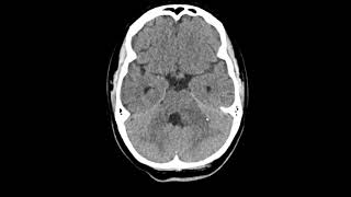 Glioma difuso da linha média [upl. by Aseel]