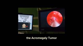 surgery for gh secreting adenoma in patient with mccune albright syndrome with fibrous dysplasia [upl. by Nyssa]