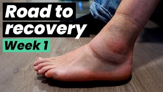 Road to Recovery  The Ankle Sprain Rehab Chronicles  week 1 [upl. by Eaver]