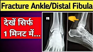 Fracture Distal Fibula  Fracture Lateral Malleolus of Fibula  XRay Ankle Joint  UdayXray [upl. by Eatnod]