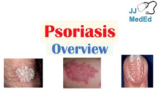 Overview of Psoriasis  What Causes It What Makes It Worse  Subtypes and Treatment [upl. by Reivax]