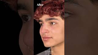 Before and After Non Surgical Nose Job nonsurgicalrhinoplasty [upl. by Anelra834]