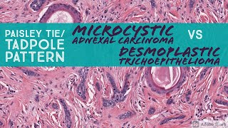 Microcystic Adnexal Carcinoma vs Desmoplastic Trichoepithelioma Paisley TieTadpole Pattern [upl. by Hescock]