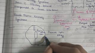 Papilloidema theory examination notes AK KHURANA [upl. by Nannek]