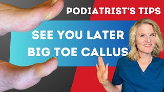 DIY Callus Care for Big ToePodiatrists Guide [upl. by Cr]