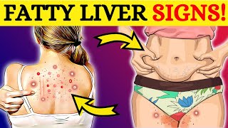 SILENT KILLER 8 HIDDEN Signs That Your Liver Is DYING Don’t Ignore [upl. by Suryc]