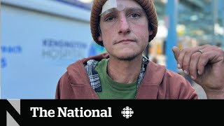 How a fleshrotting ‘zombie drug’ is complicating the overdose crisis [upl. by Adekram]