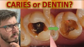 Until Where to Remove Caries on Dentin TUTORIAL Deep Caries Removal How to Radiology Detection [upl. by Ibbed342]