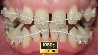 🔥HOW BRACES WORK  TIMELAPSE of Terrible GUMMY smile and DEEP bite [upl. by Thilde]