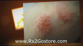 Clobetasol Cream  How to Treat Psoriasis and Eczema [upl. by Dore]