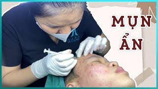 Big Cystic Acne Blackheads Extraction Blackheads amp Milia Whiteheads Removal Pimple Popping [upl. by Annoved37]