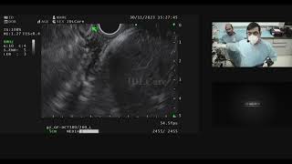 Linear EUS  mediastinum and alpha manoeuvre [upl. by Selokcin]