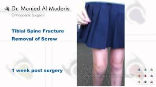 Tibial Spine Fracture Screw Removal  1 week post surgery [upl. by Connolly680]