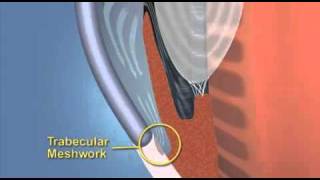 Primary Angle Closure Glaucoma Explained With Animation [upl. by Leamaj3]