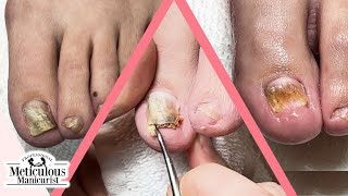 How to Fix Toenails that Change Shape and Color [upl. by Llertrac369]