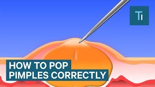 The Only Right Way To Pop Your Pimples [upl. by Chelsae]