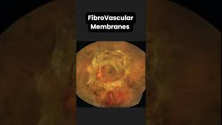 Tractional Retinal Detachment ophthalmologyretina [upl. by Aneekal]