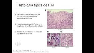 GASTROENTEROLOGÍA 7 Hepatitis crónica [upl. by Bailar]