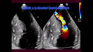 HOCM sp Alcohol septal ablation TTEDoppler [upl. by Deborath563]